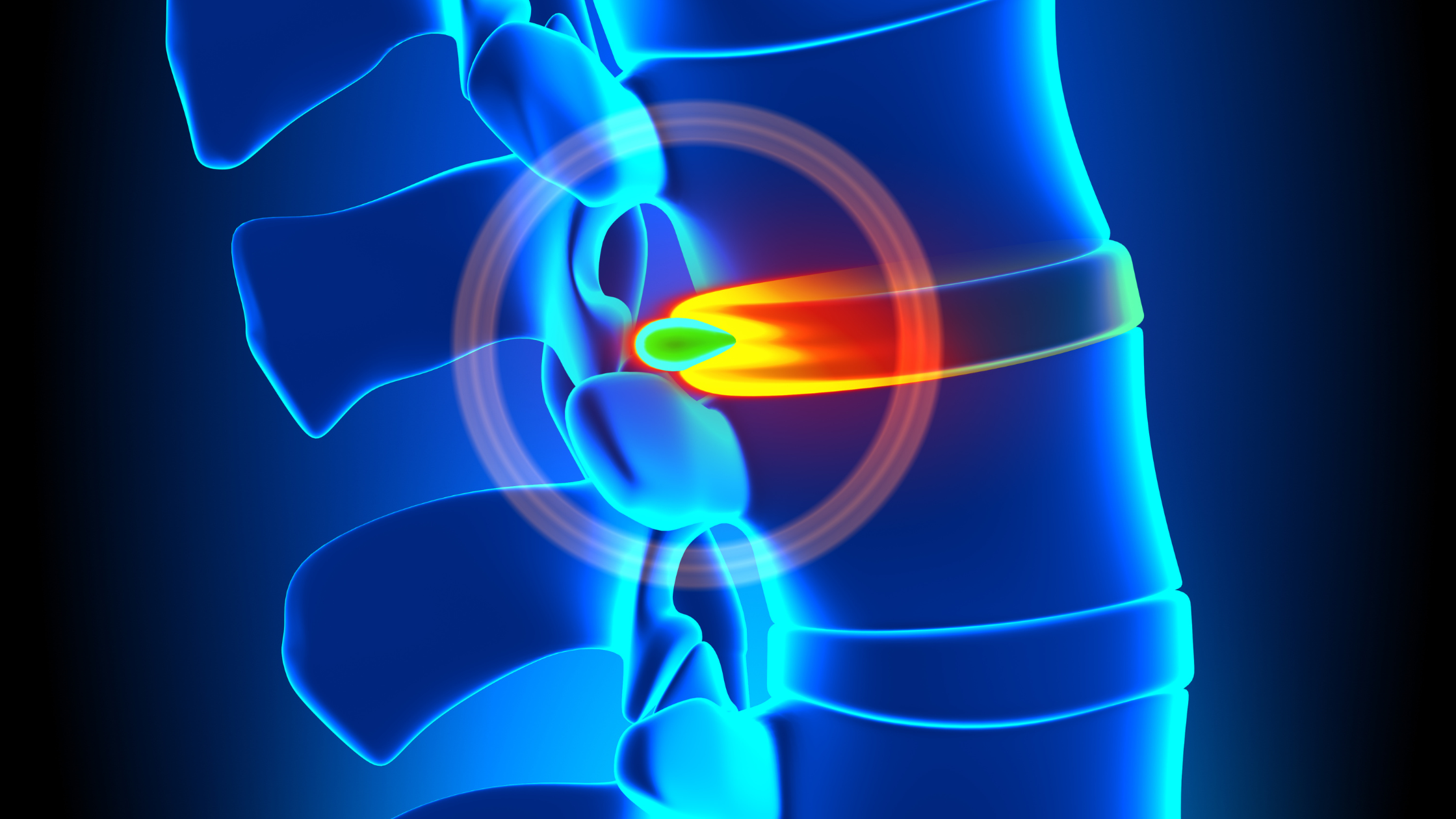 Discseel® Procedure Explained: A Minimally Invasive Option For Chronic Disc-Related Back Pain
